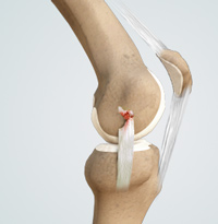 Knee Medical Collateral Ligament (MCL) Injury