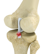 Knee Posterior Cruciate Ligament (PCL) Injury
