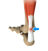 Achilles Tendon Tears