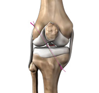 Anterior Cruciate Ligament (ACL) Reconstruction