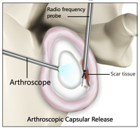Arthroscopic Capsular Release/ Manipulation Under Anesthesia