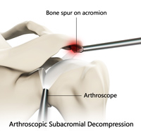 Arthroscopic Subacromial Decompression