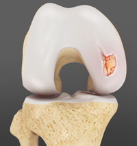 Articular Cartilage Injury