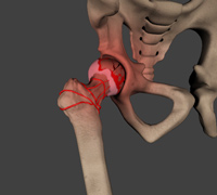 Avascular Necrosis of the Hip