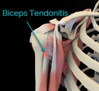 Biceps Tendinitis