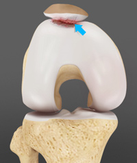 Chondromalacia Patella