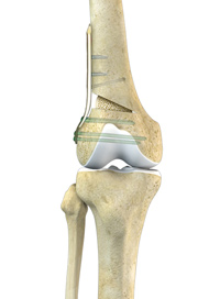 Distal Femoral Osteotomy