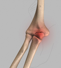 Elbow Fractures