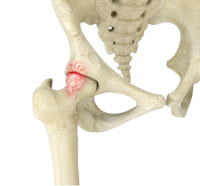 FAI - Femoroacetabular Impingement