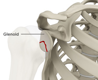 Glenoid Fractures