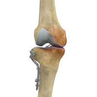 High Tibial Osteotomy