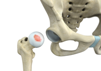 Hip Chondral Injuries