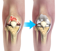 Knee Replacement