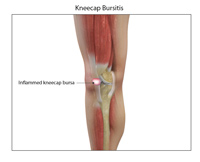 Prepatellar/ Kneecap Bursitis