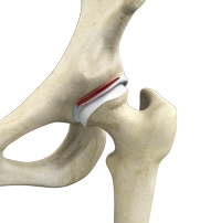 Labral Tear