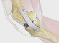 Medial Collateral Ligament (MCL) Reconstruction