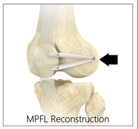 Medial Patellofemoral Ligament (MPFL) Reconstruction