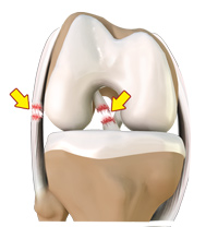 Multi-Ligament Injury