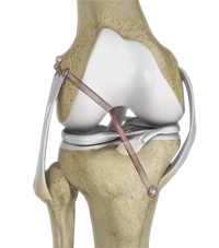Multi-Ligament Knee Reconstruction