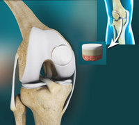 Osteochondral Allograft Transplantation