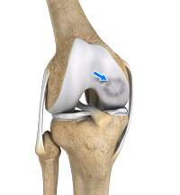 Osteochondritis Dissecans