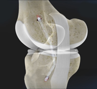 Posterior Cruciate Ligament (PCL) Reconstruction