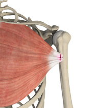 Pectoralis Muscle Rupture