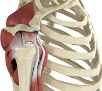 Rotator Cuff Tear