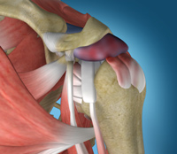 Shoulder Impingement/Rotator Cuff Tendinitis
