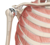 Shoulder Joint Replacement