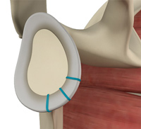 Shoulder Labrum Repair/Reconstruction