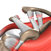 Shoulder Separation