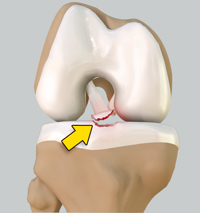 Tibial Eminence Spine Avulsions