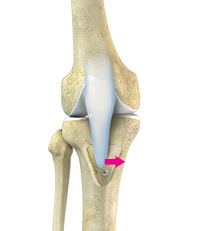 Tibial Tubercle Osteotomy